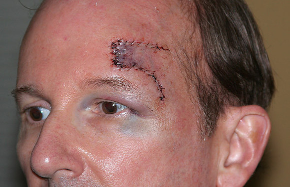 My scar